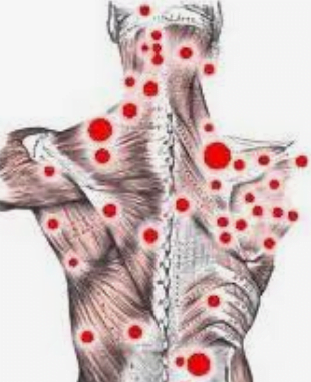 فیبرومیالژی